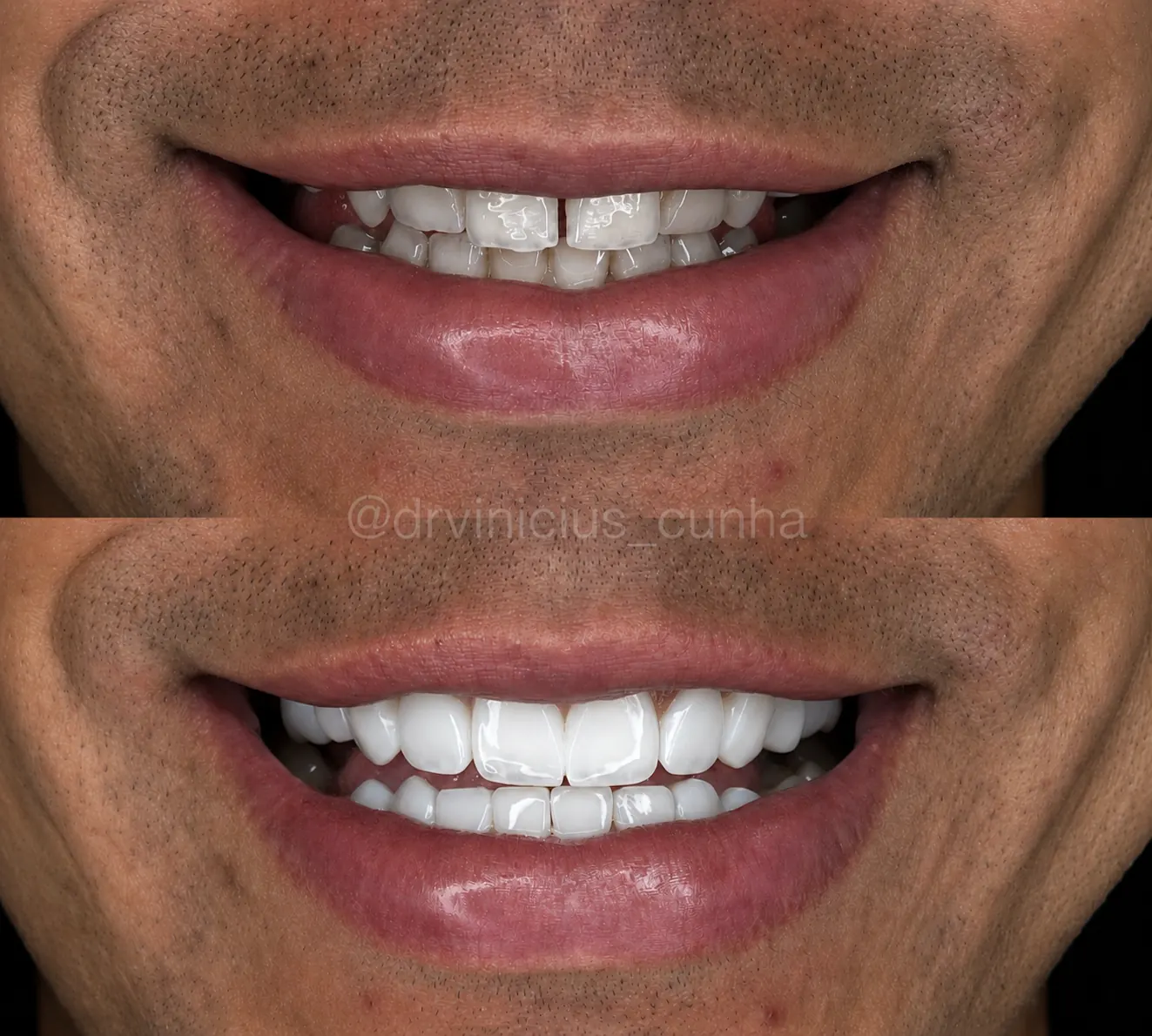 Antes e depois aproximado de sorriso masculino com lentes em resina