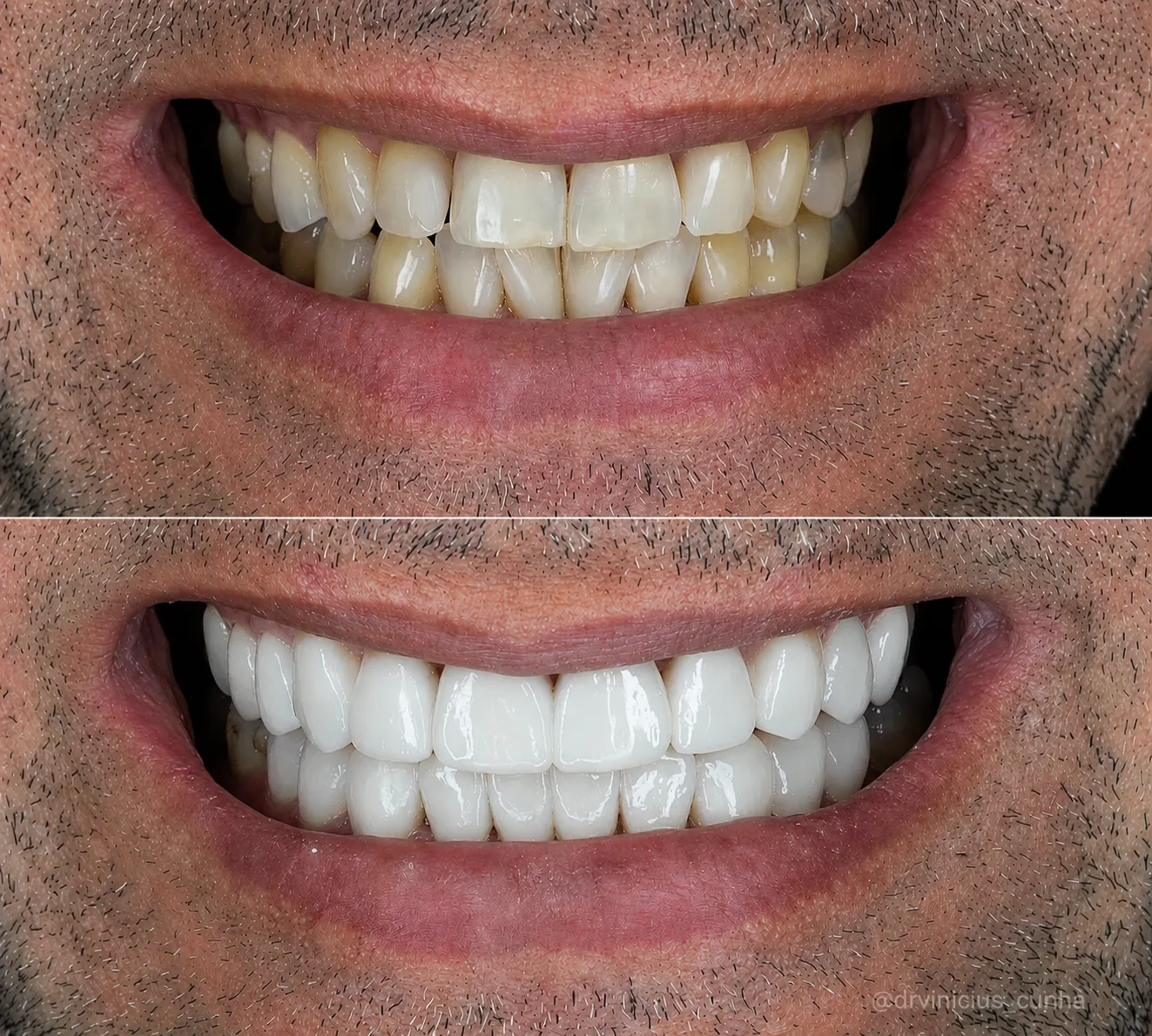 Antes e depois aproximado de sorriso masculino com lentes em resina