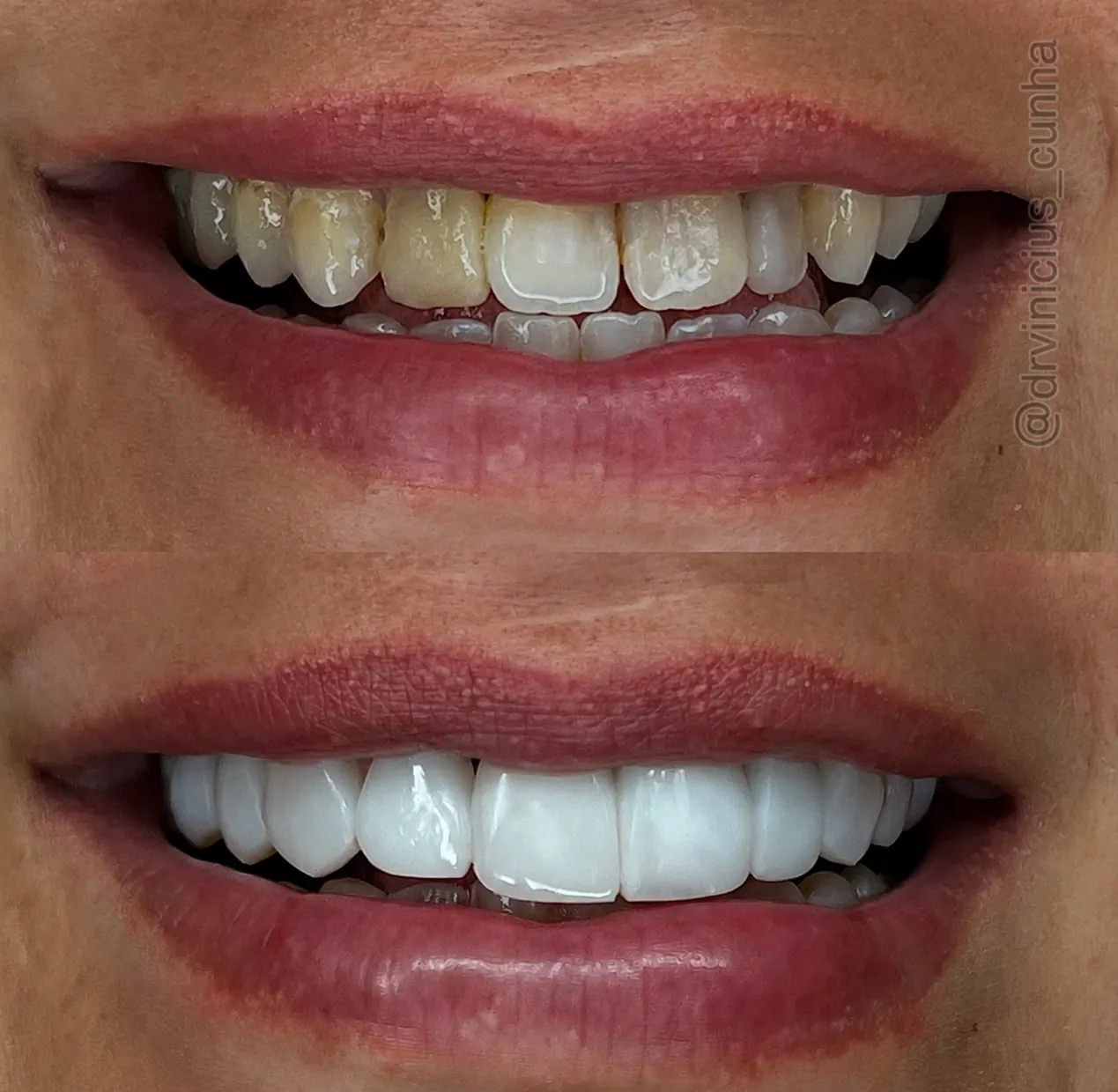 Antes e depois lateral de sorriso com lentes em resina