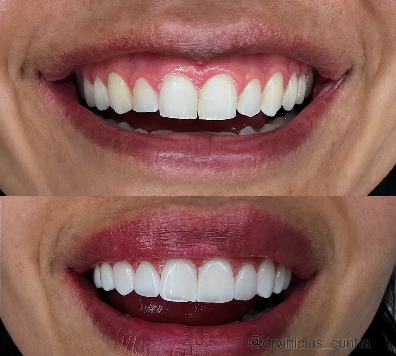 Antes e depois de sorriso com lentes em resina