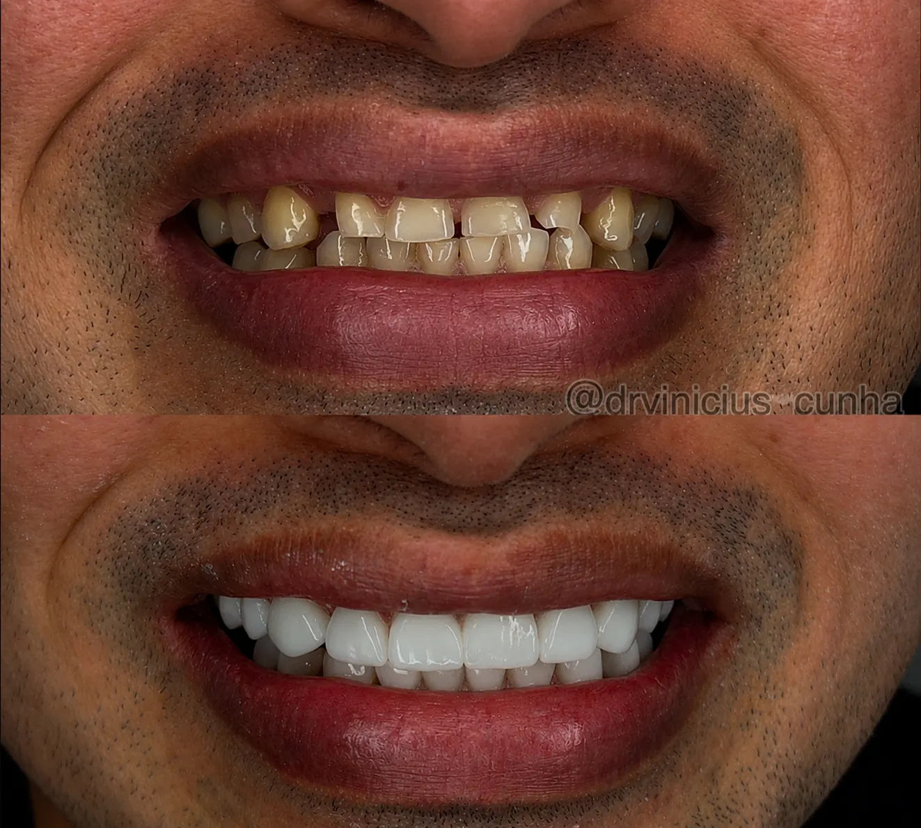 Antes e depois de sorriso com lentes em resina