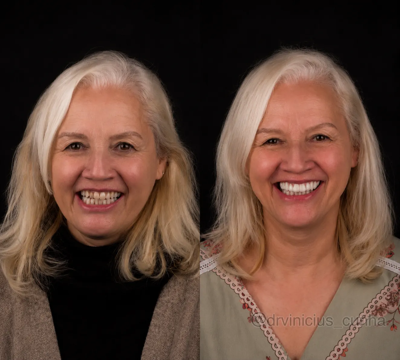 Antes e depois de paciente feminina com lentes em resina