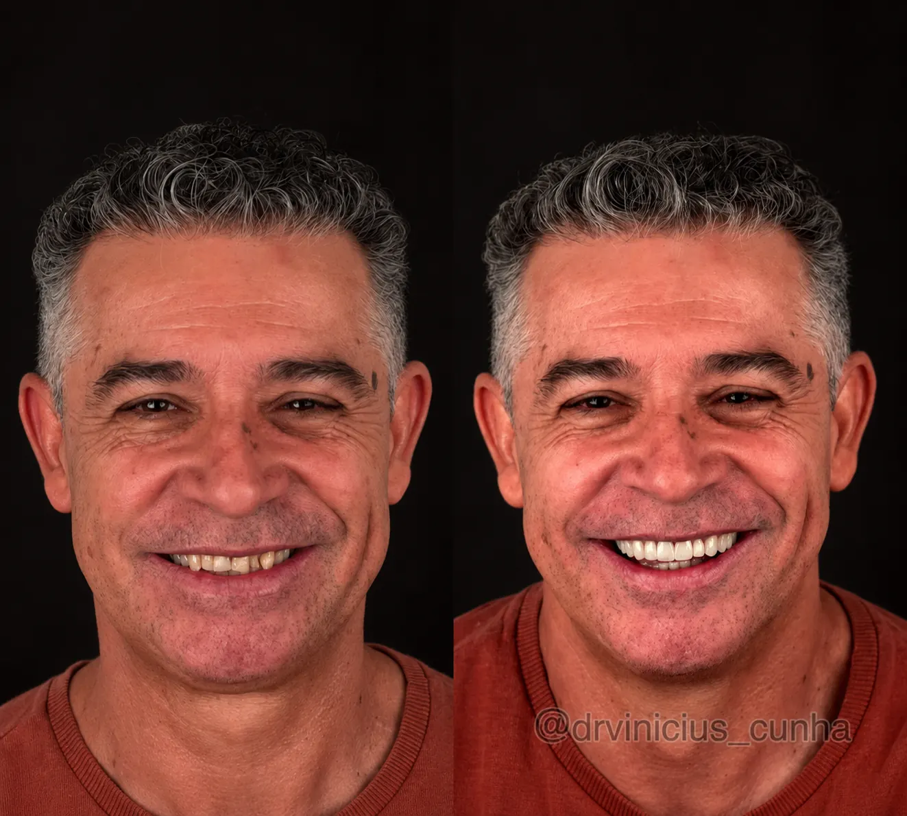 Antes e depois de paciente masculino com lentes em resina
